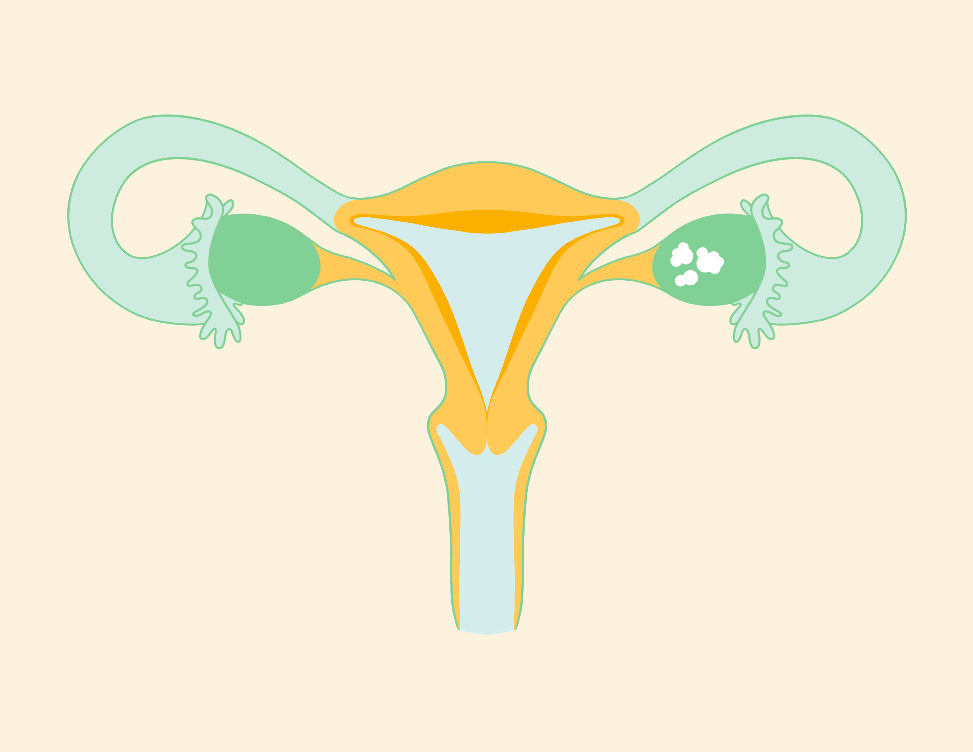 Ovarian cancer Stage 1