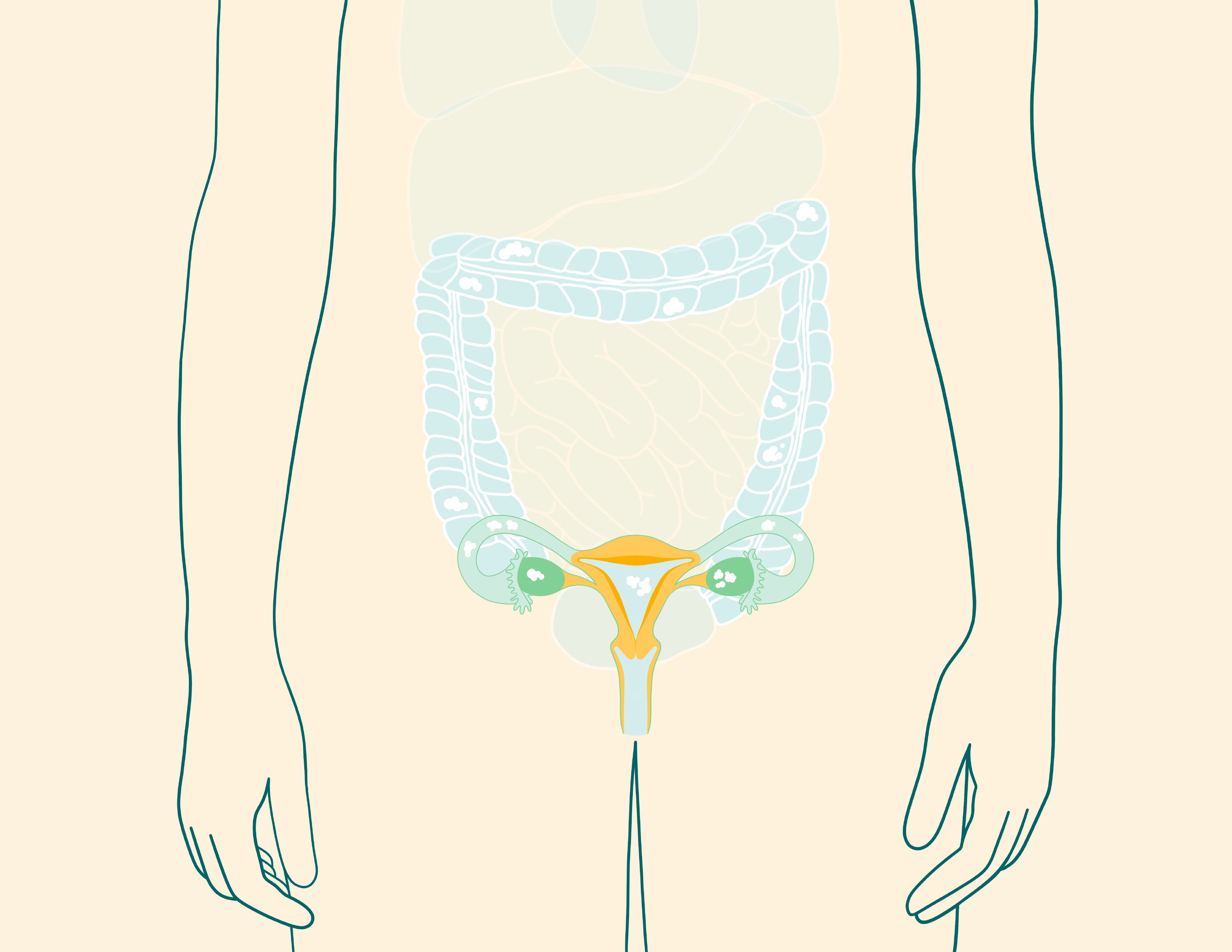 Ovarian cancer Stage 3